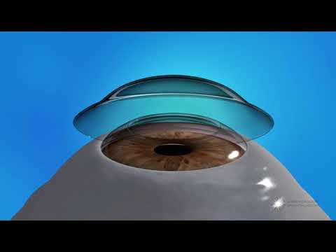 What Is Photorefractive Keratectomy (PRK)?