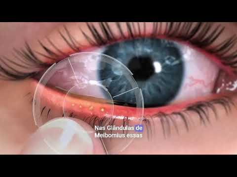 dry eye 1