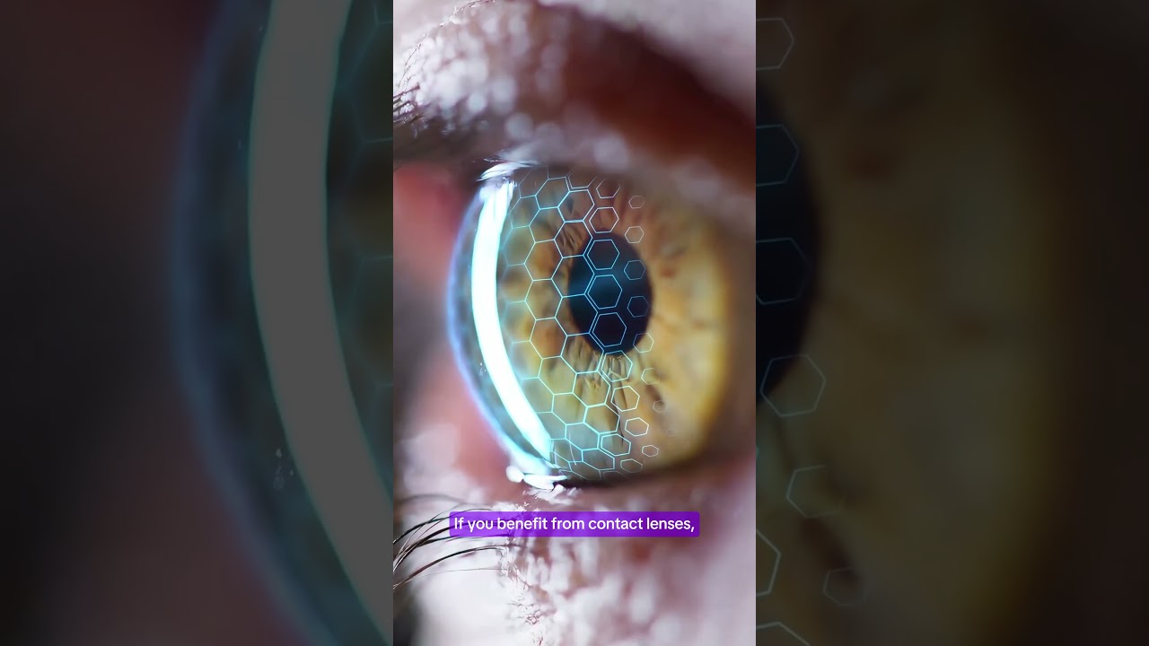 Keratokonus Hastaları için CAIRS mi, Kontakt Lens mi?