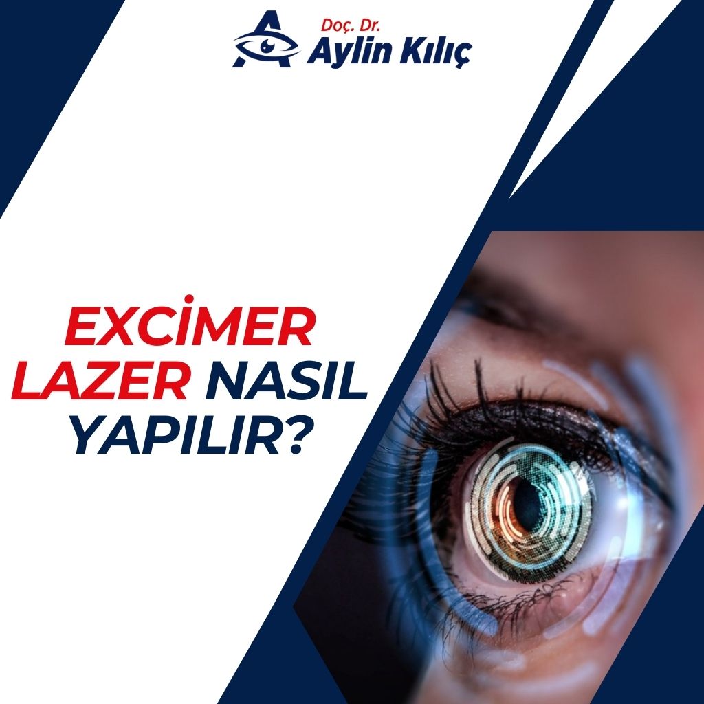 Excimer Lazer Nasıl Yapılır