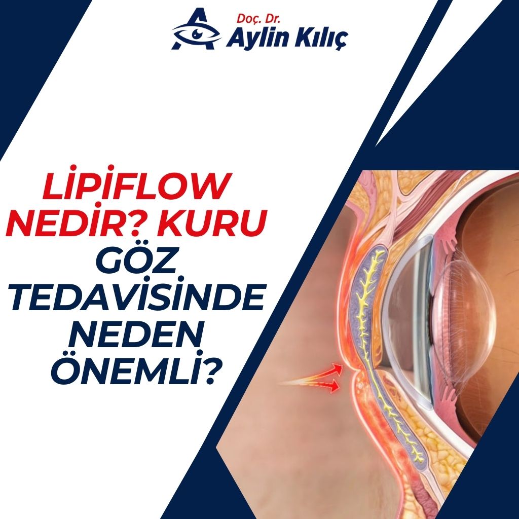 Lipiflow Nedir Kuru Goz Tedavisinde Neden Onemli