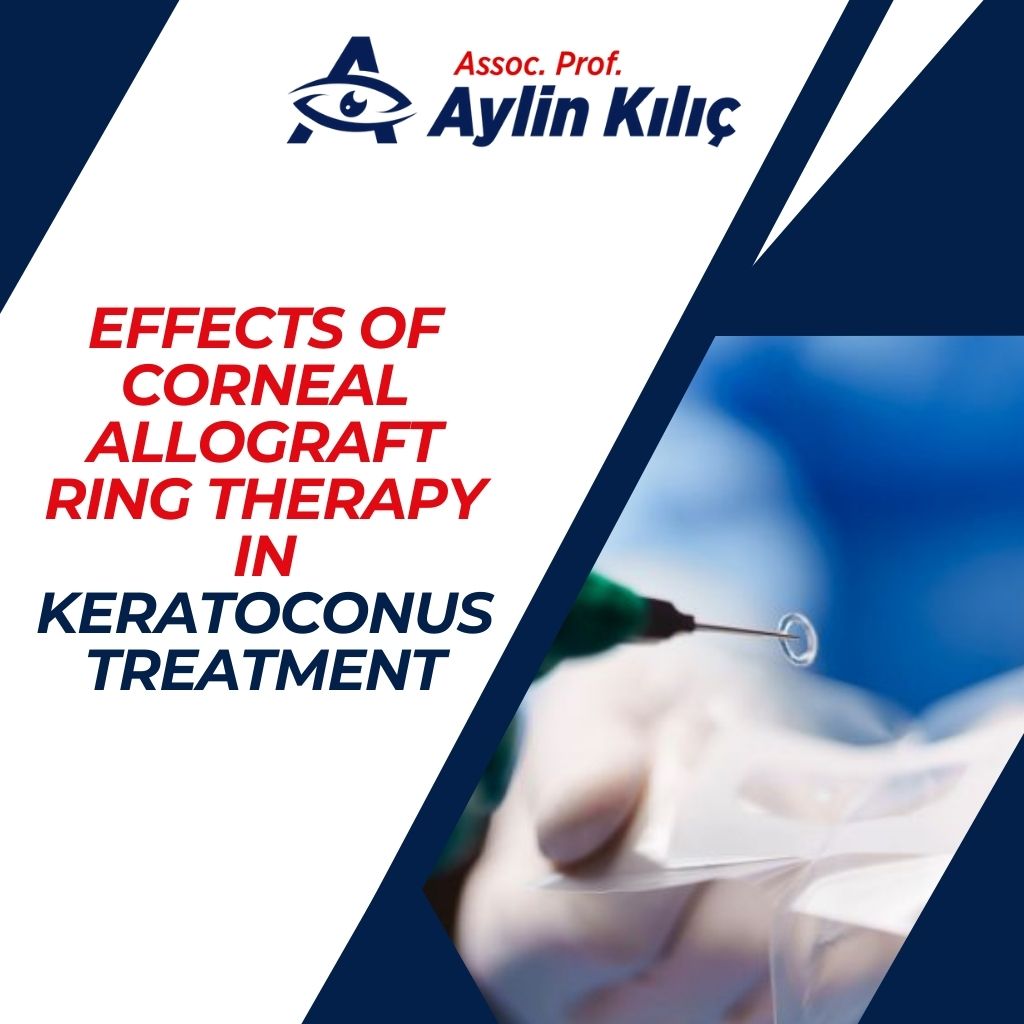 Effects of Corneal Allograft Ring Therapy in Keratoconus Treatment