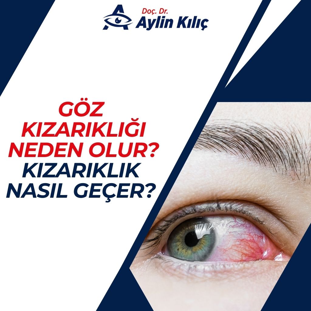 Göz Kızarıklığı Neden Olur Kızarıklık Nasıl Geçer