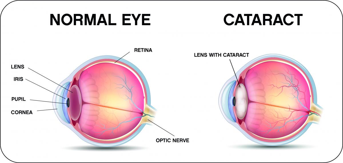 Katarakt ameliyatı
