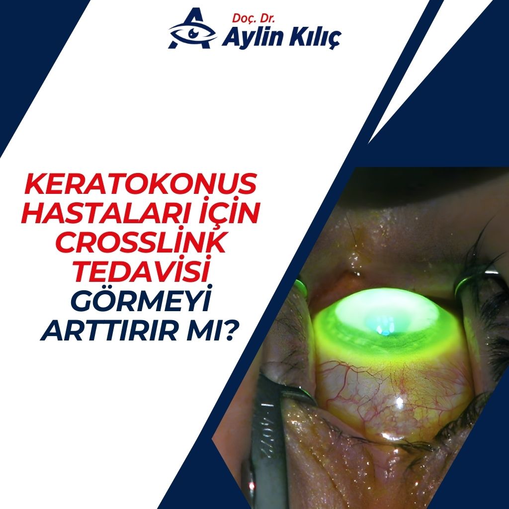 Keratokonus Hastaları için Crosslink Tedavisi Görmeyi Arttırır mı