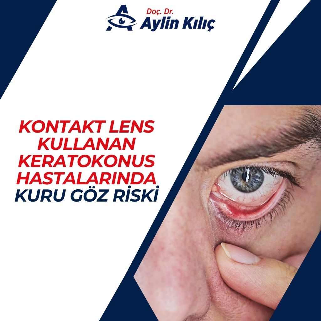 Kontakt Lens Kullanan Keratokonus Hastalarında Kuru Göz Riski