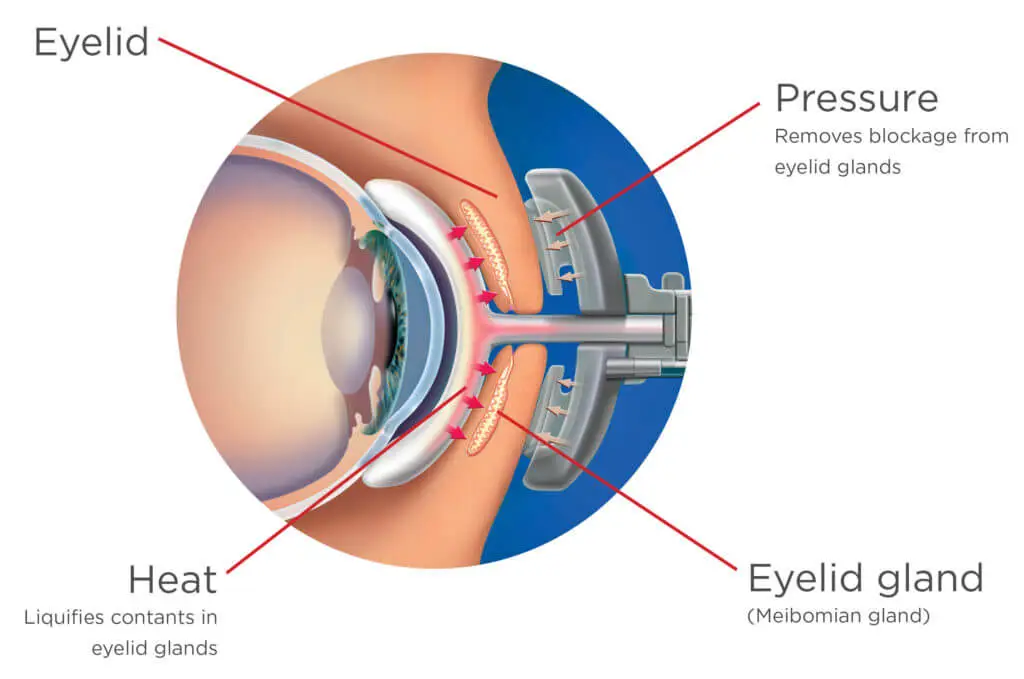 Lipiflow eyes