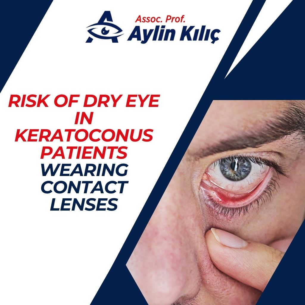 Risk of Dry Eye in Keratoconus Patients Wearing Contact Lenses