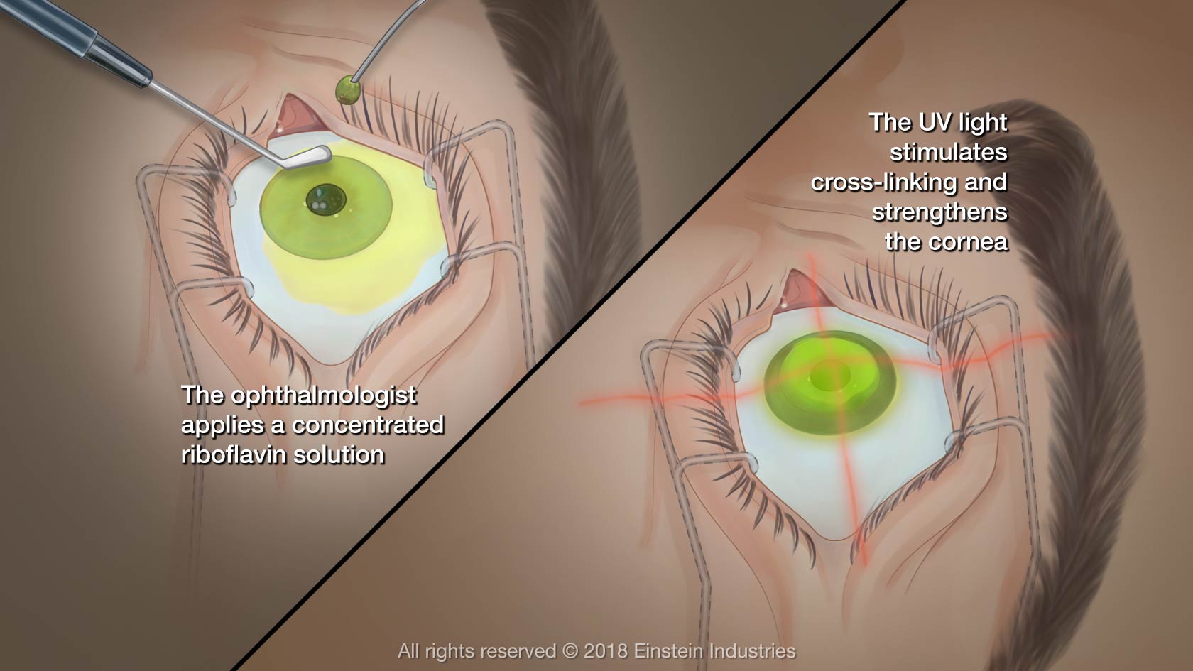 keratoconus Crosslink