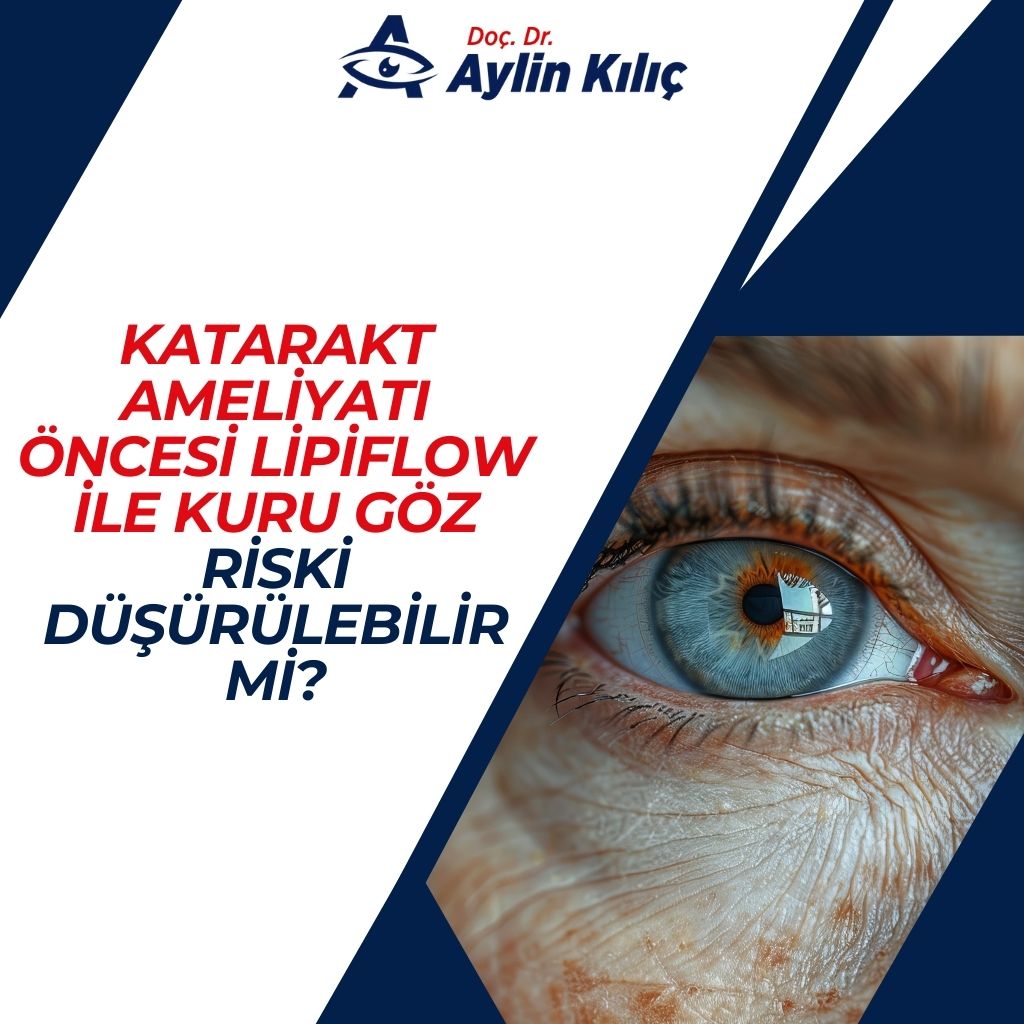 Katarakt Ameliyatı Öncesi Lipiflow ile Kuru Göz Riski Düşürülebilir mi