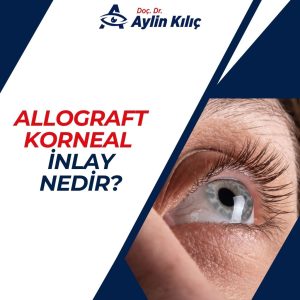 Allograft korneal inlay