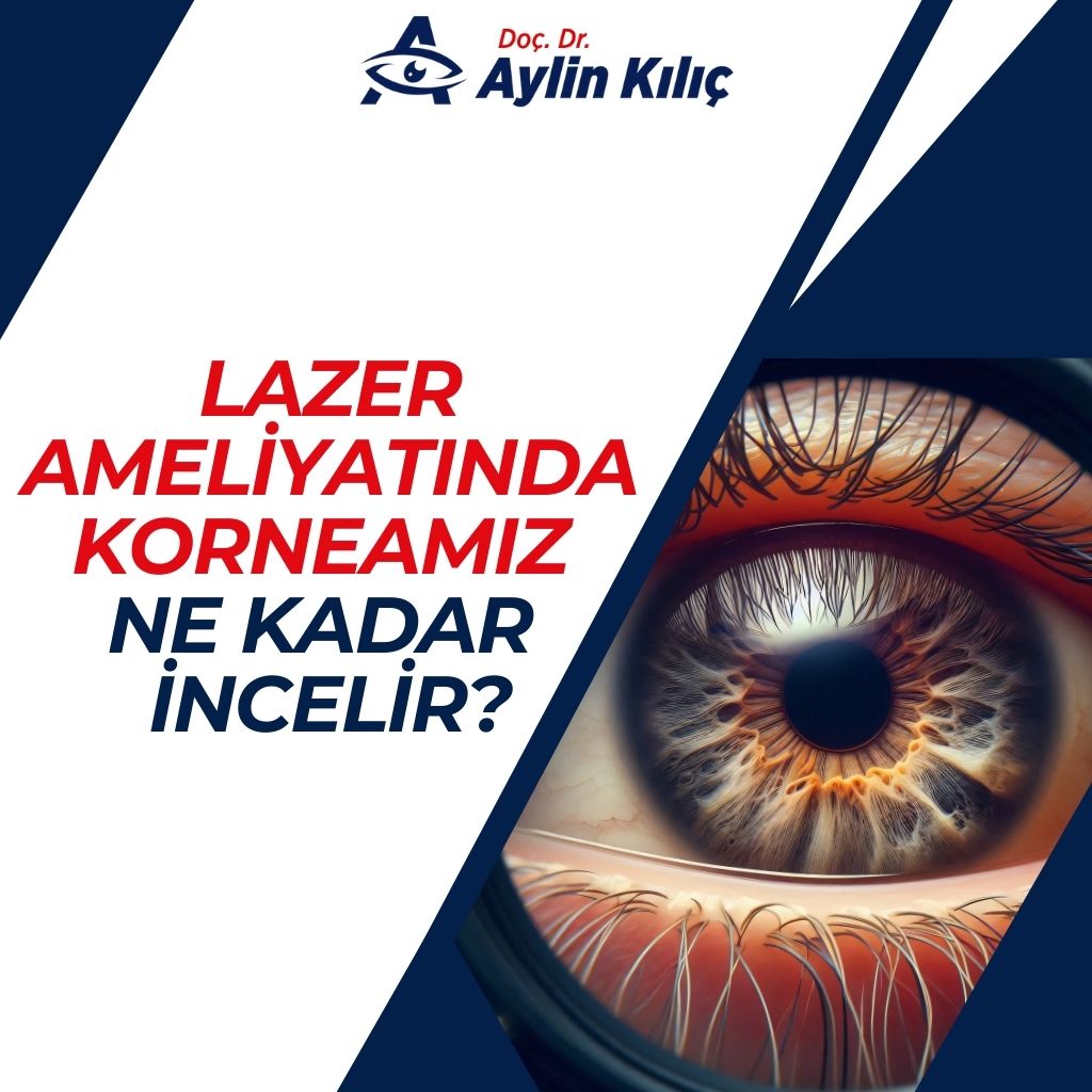 Lazer Ameliyatında Korneamız Ne Kadar İncelir