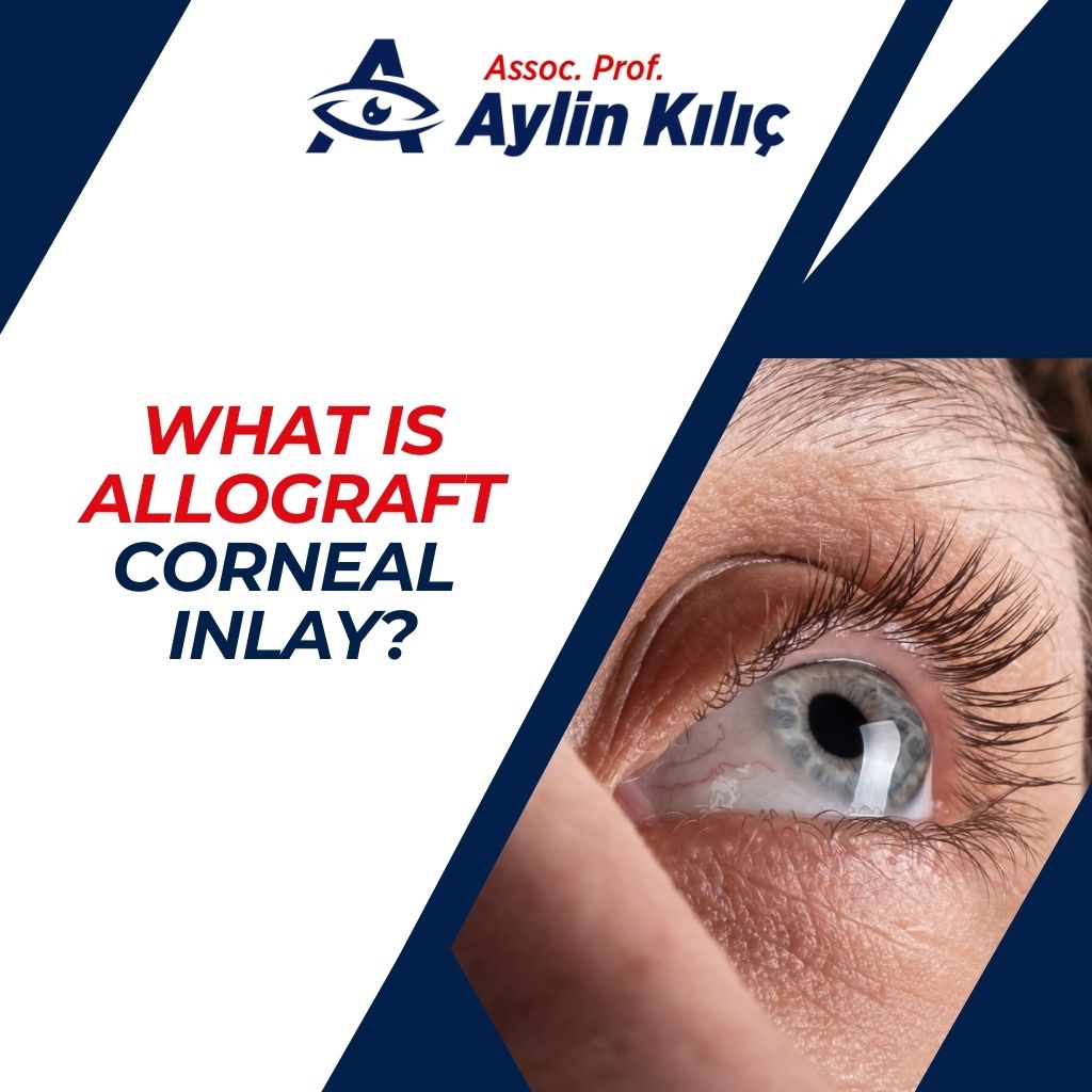 What is Allograft Corneal Inlay