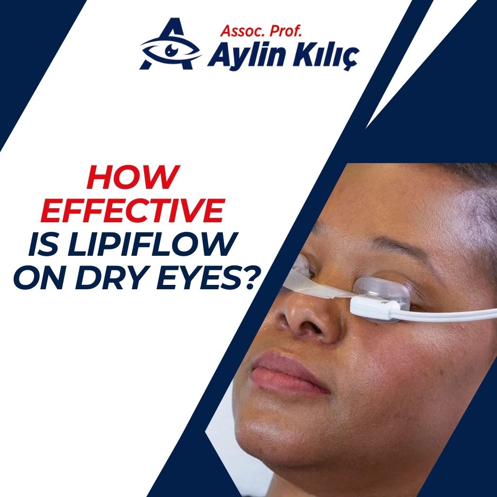 How Effective is Lipiflow on Dry Eyes