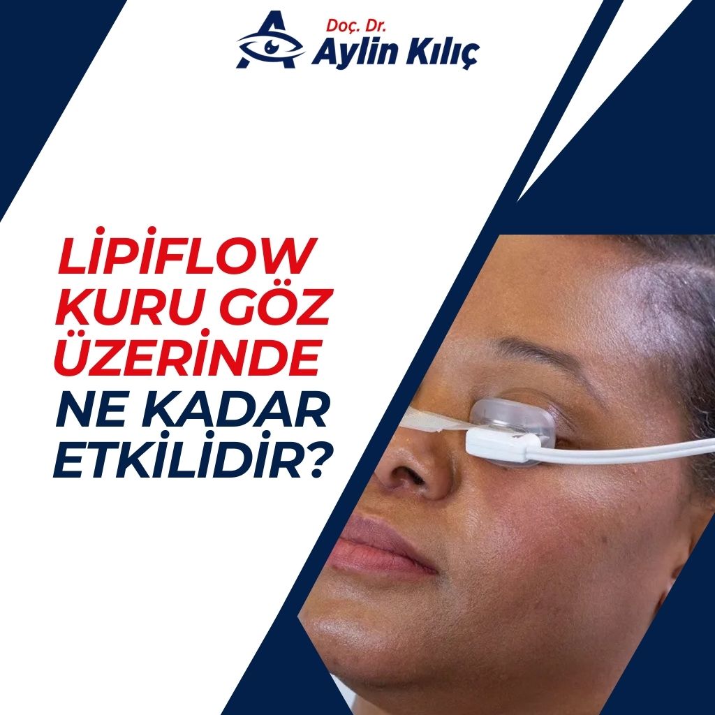 Lipiflow Kuru Göz Üzerinde Ne Kadar Etkilidir