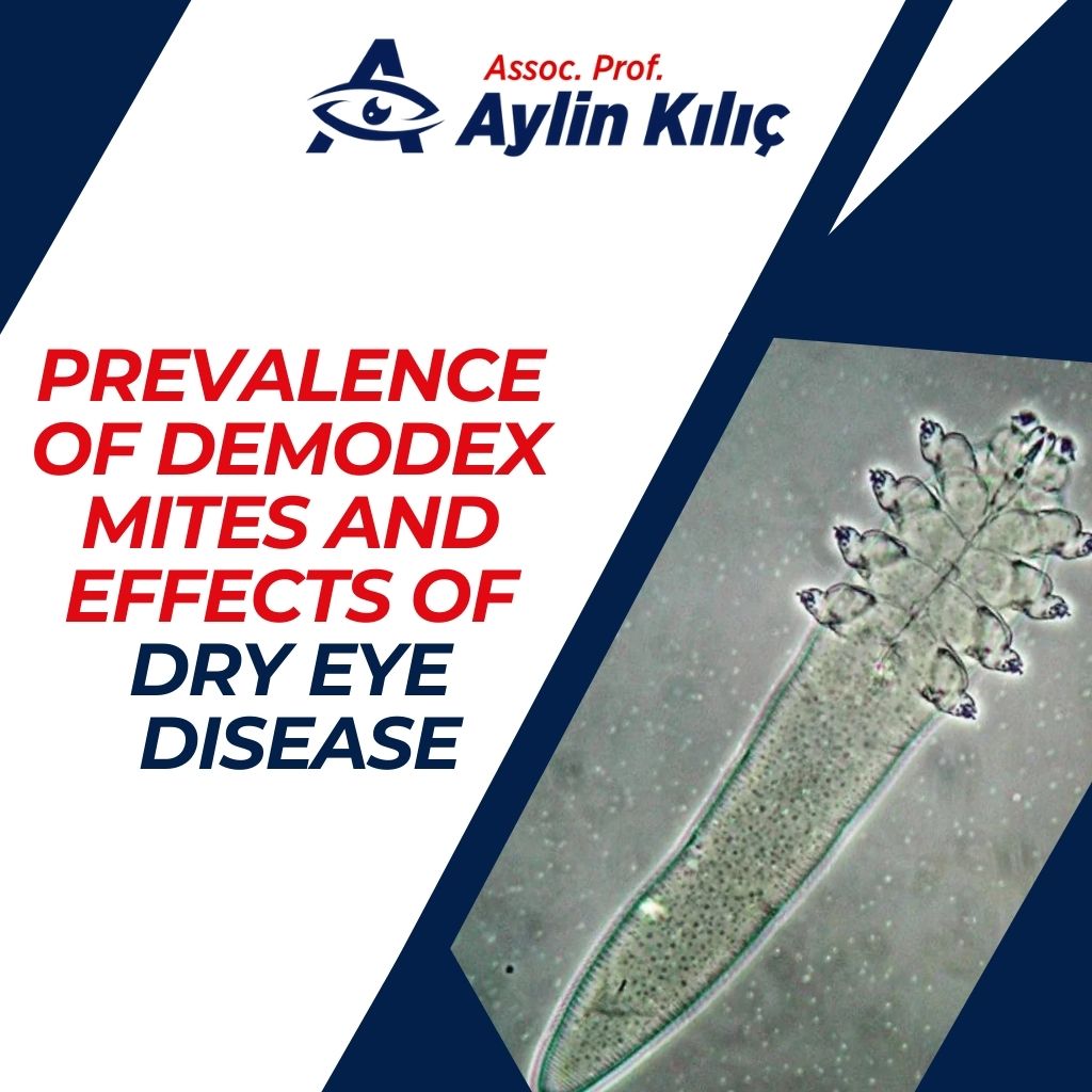 Prevalence of Demodex Mites and Effects of Dry Eye Disease