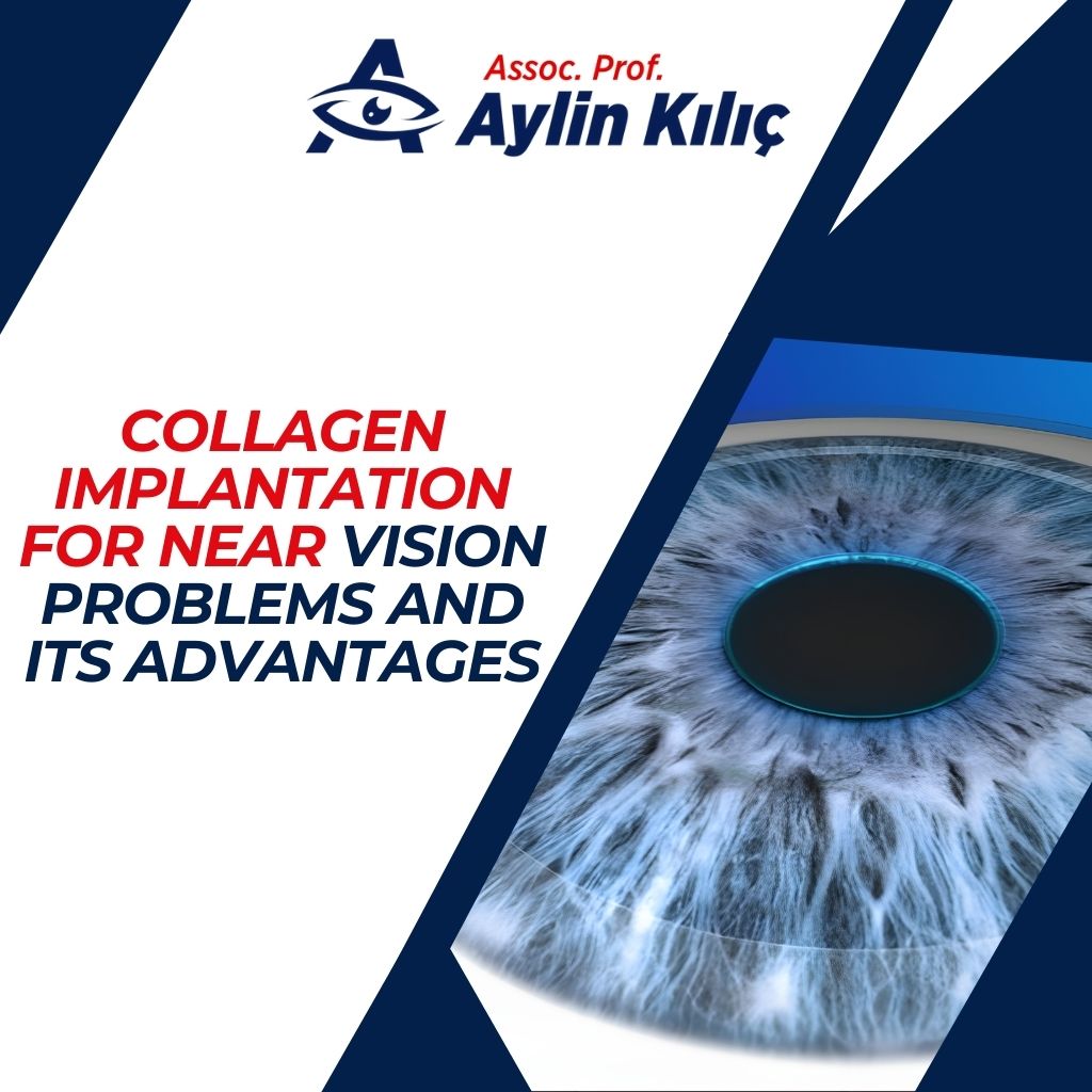 Collagen Implantation for Near Vision Problems and Its Advantages