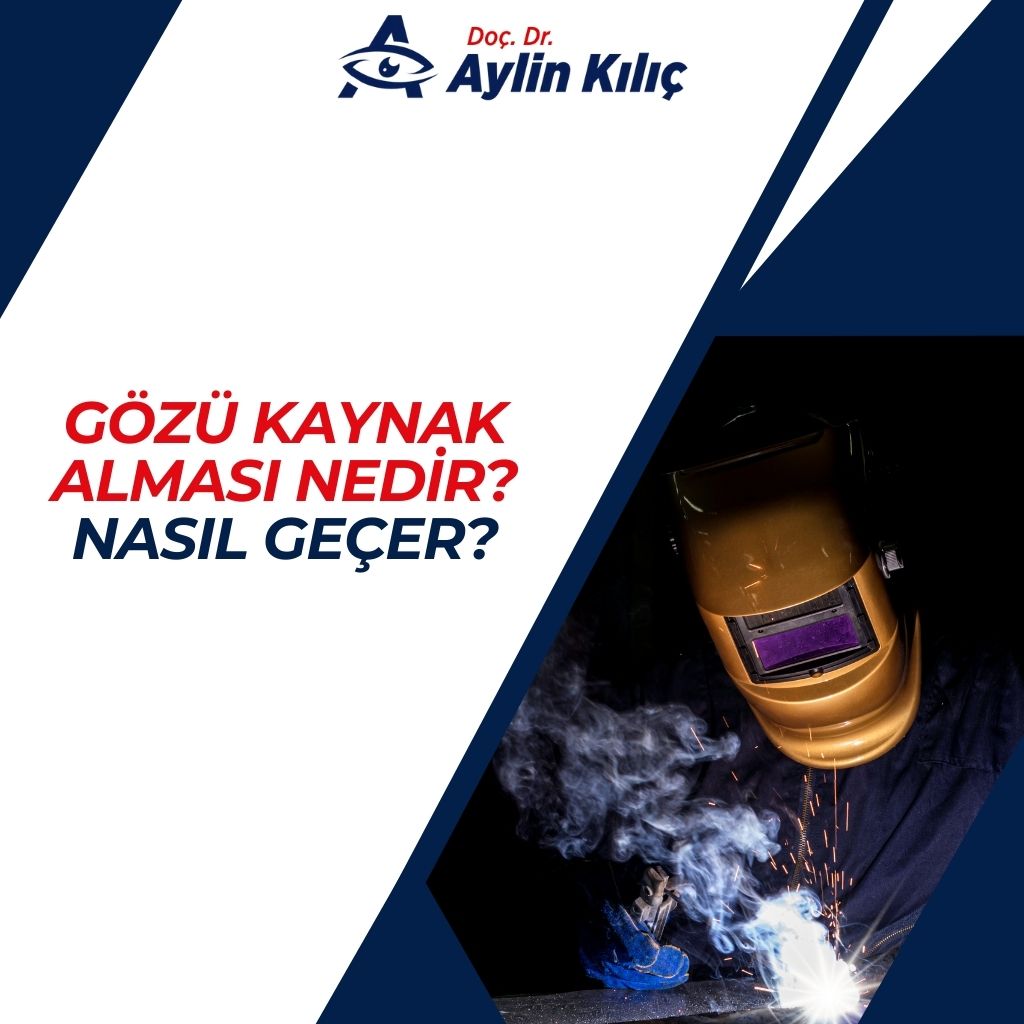 Gözü Kaynak Alması Nedir Nasıl Geçer