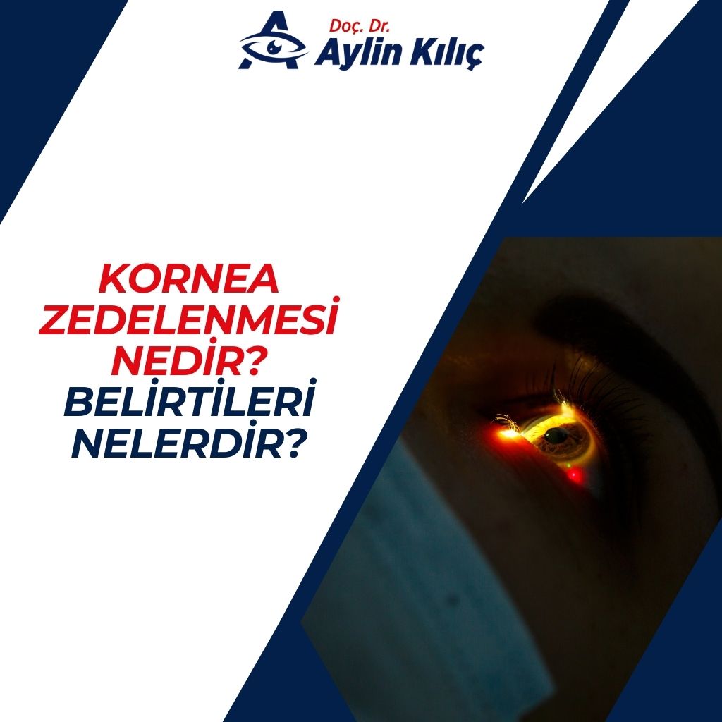 Kornea Zedelenmesi Nedir Belirtileri Nelerdir