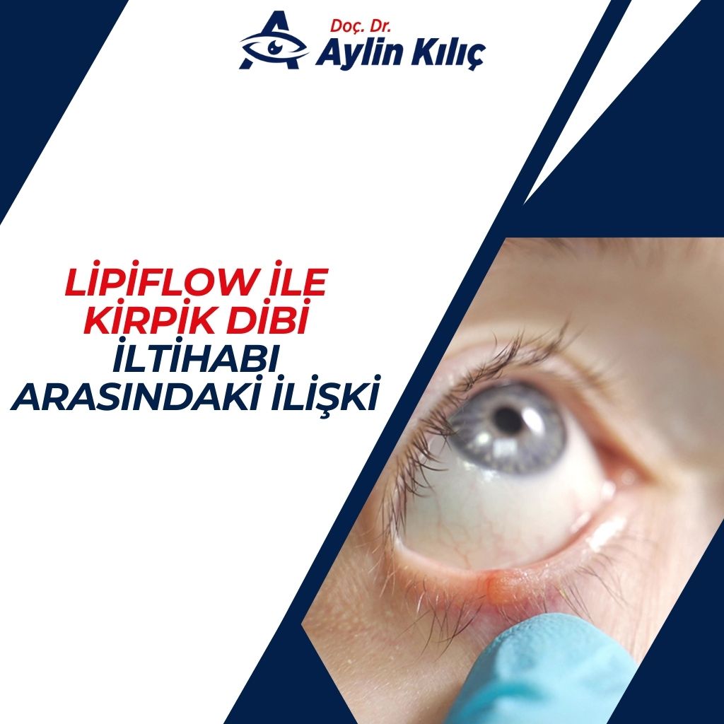 LipiFlow ile Kirpik Dibi İltihabı Arasındaki İlişki