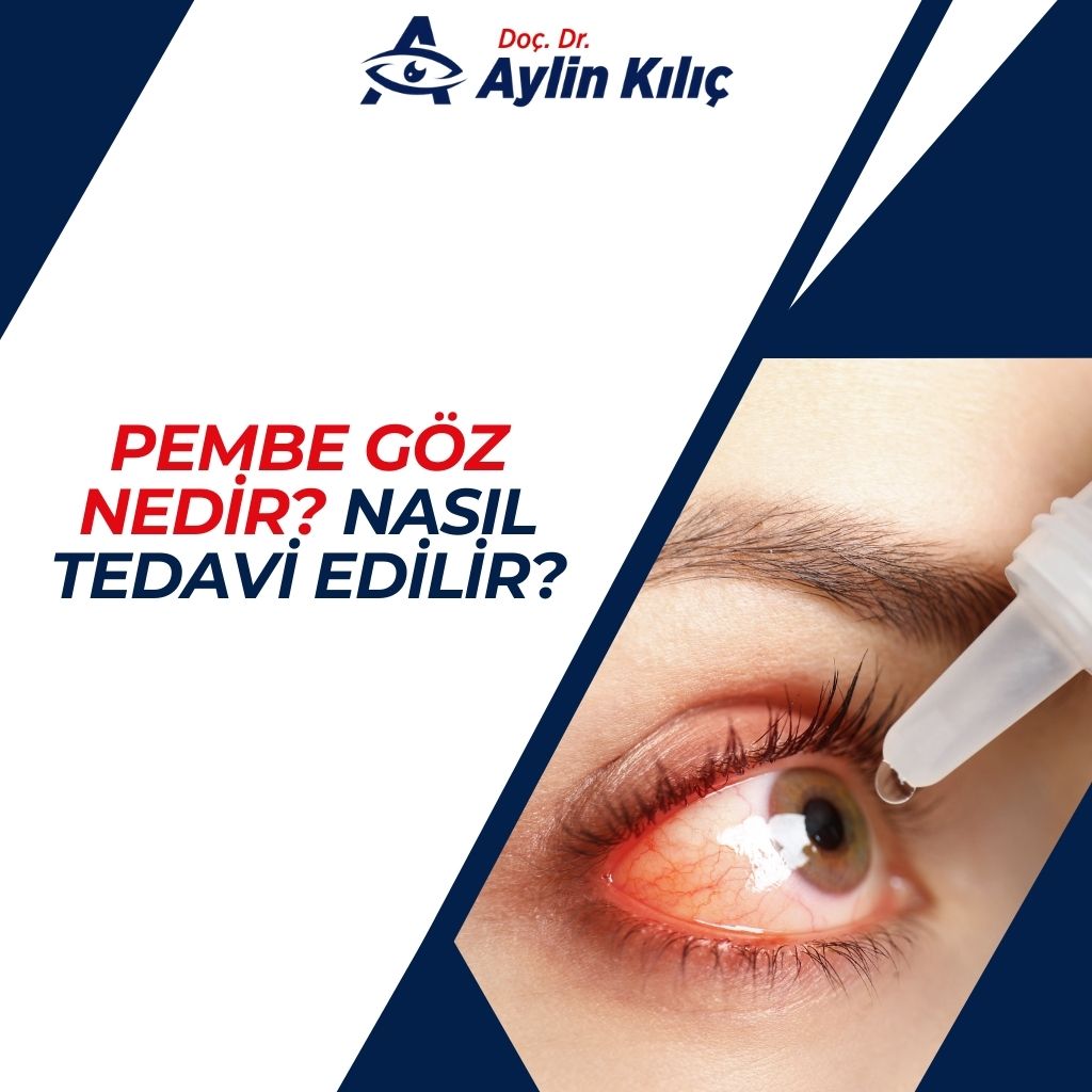 Pembe Göz Nedir Nasıl Tedavi Edilir