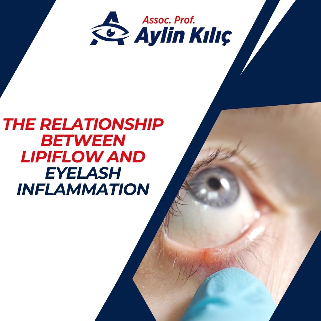 The Relationship Between LipiFlow and Eyelash Inflammation