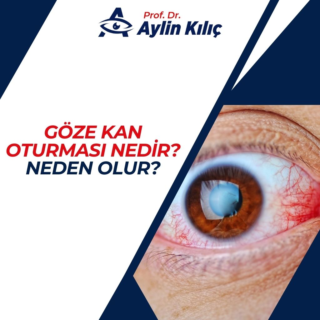 Göze Kan Oturması Nedir Neden Olur