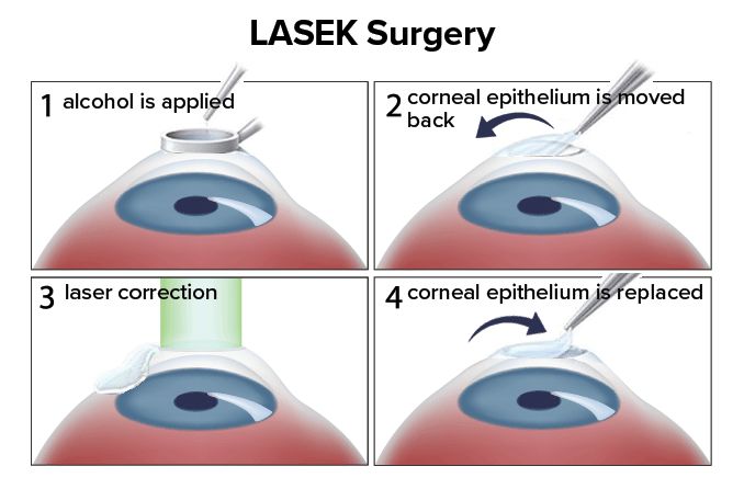 LASEK Nedir 2