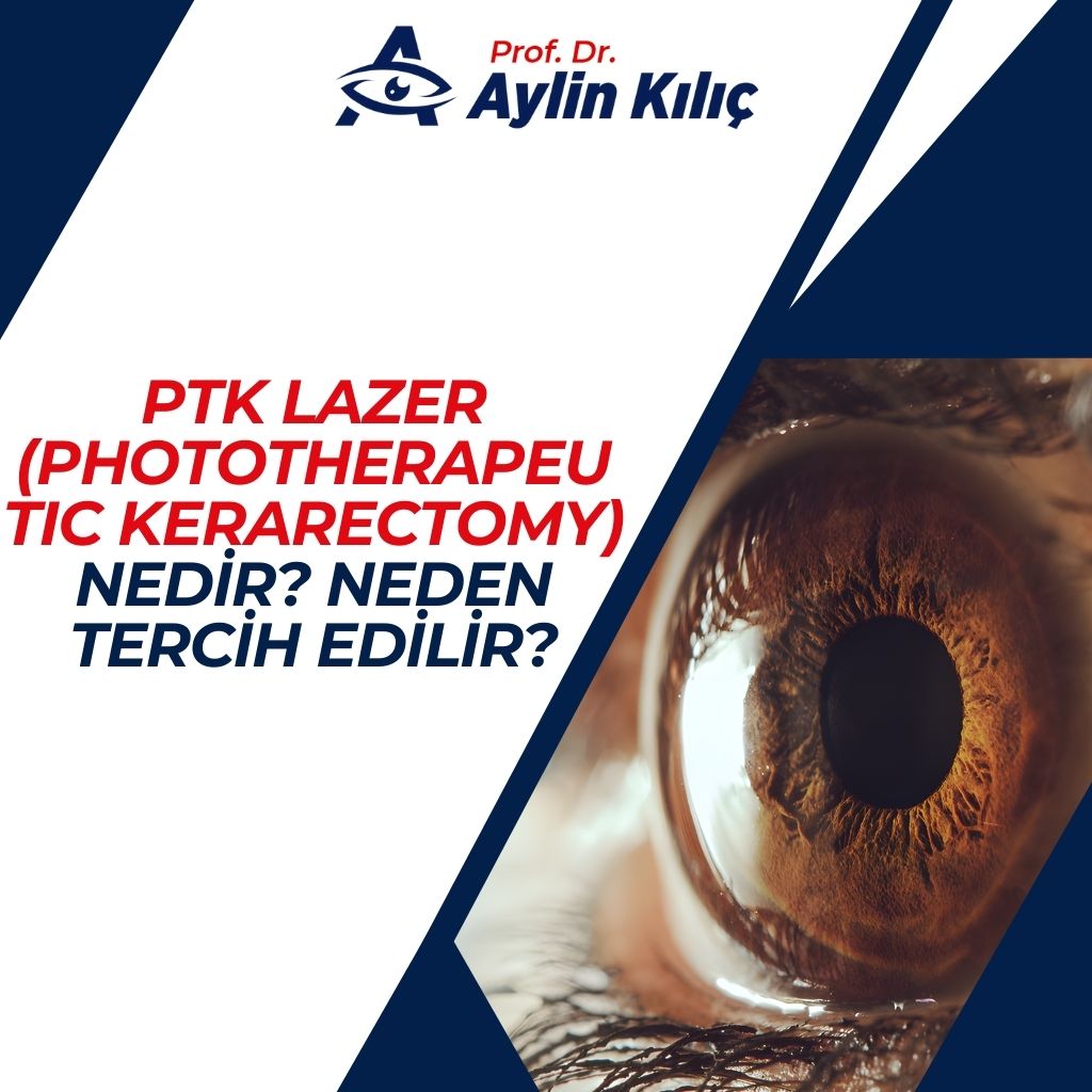 PTK Lazer (Phototherapeutic Kerarectomy) Nedir Neden Tercih Edilir