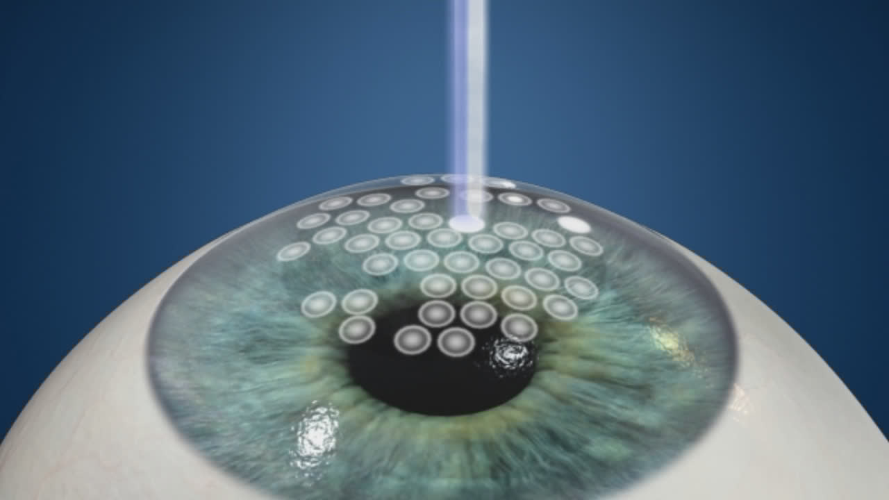 PTK Lazer (phototherapeutic Kerarectomy) 2