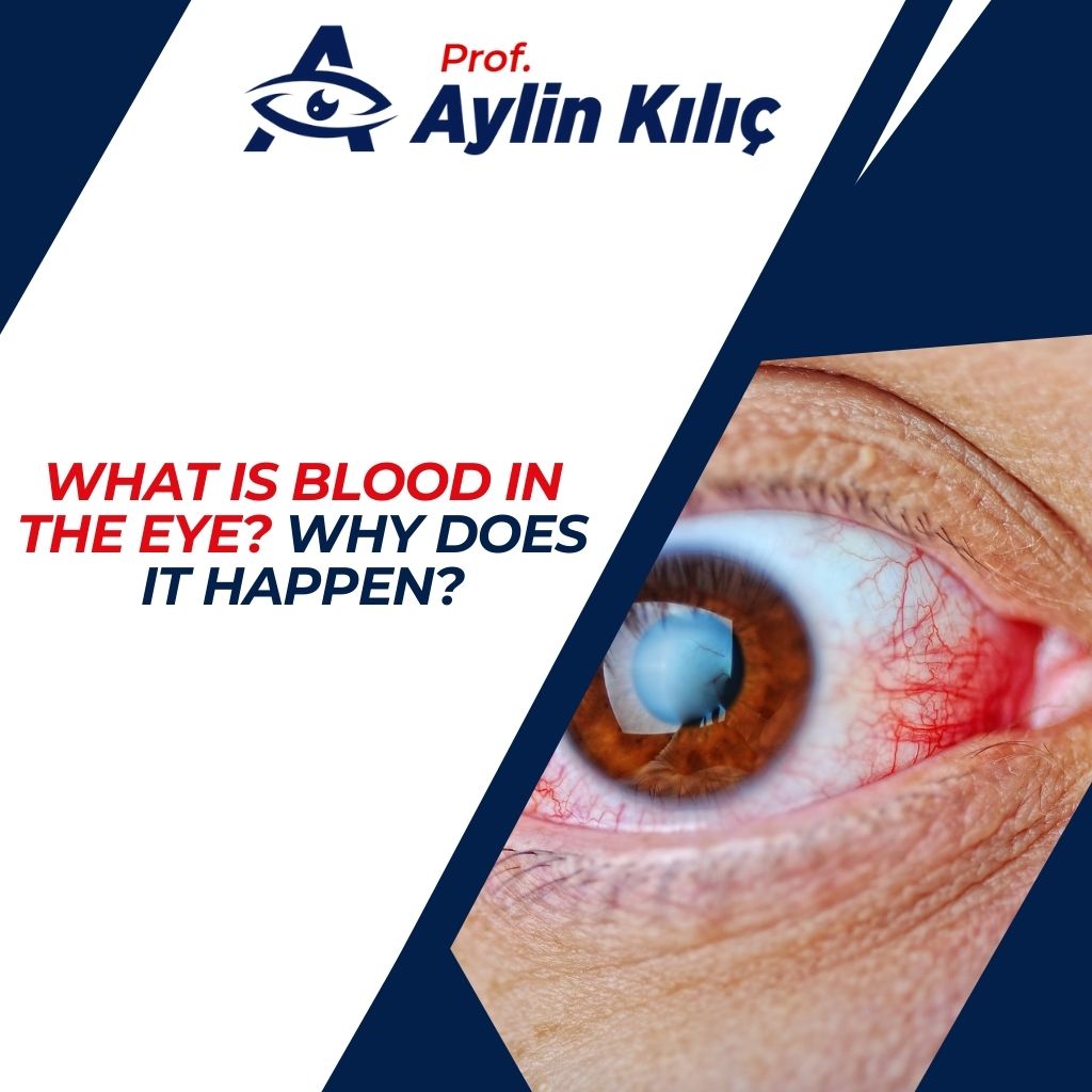 What is Blood in the Eye Why Does It Happen