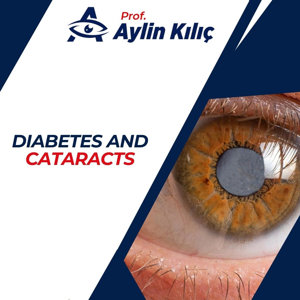 Diabetes and Cataracts