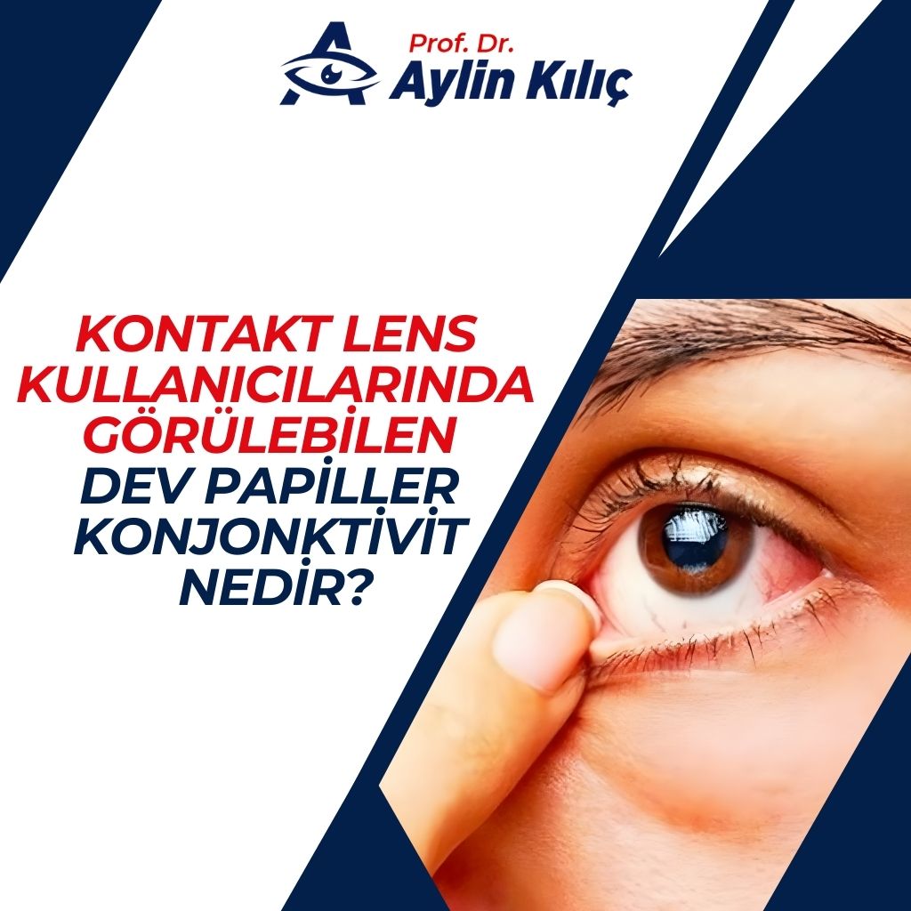 Kontakt Lens Kullanıcılarında Görülebilen Dev Papiller Konjonktivit Nedir