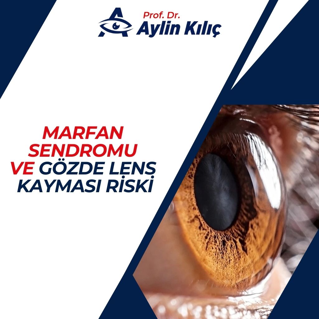 Marfan Sendromu ve Gözde Lens Kayması Riski