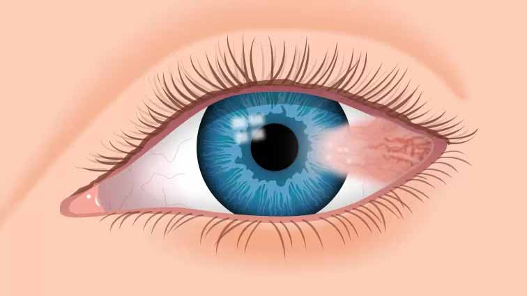 Pterjium (Göz Eti) 2