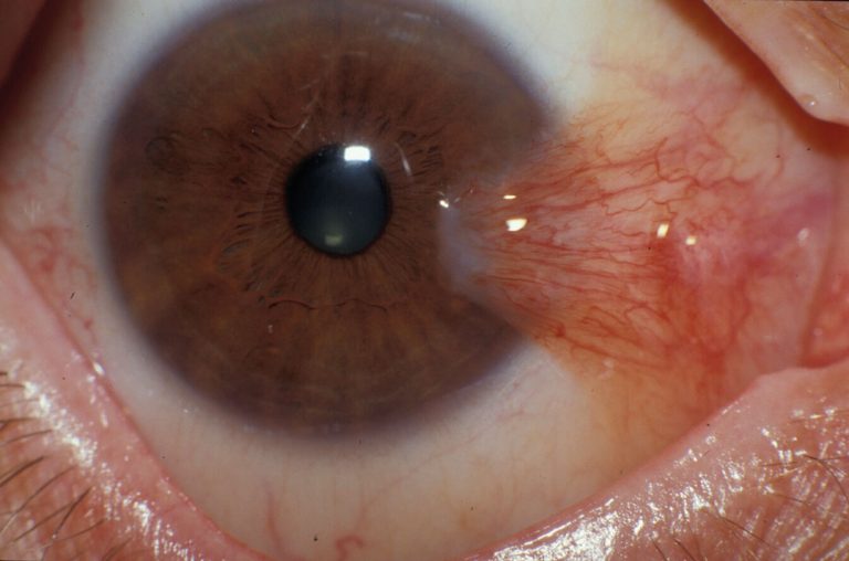 Pterjium (Göz Eti) 4