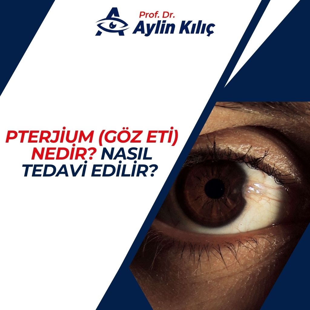 Pterjium (Göz Eti) Nedir Nasıl Tedavi Edilir