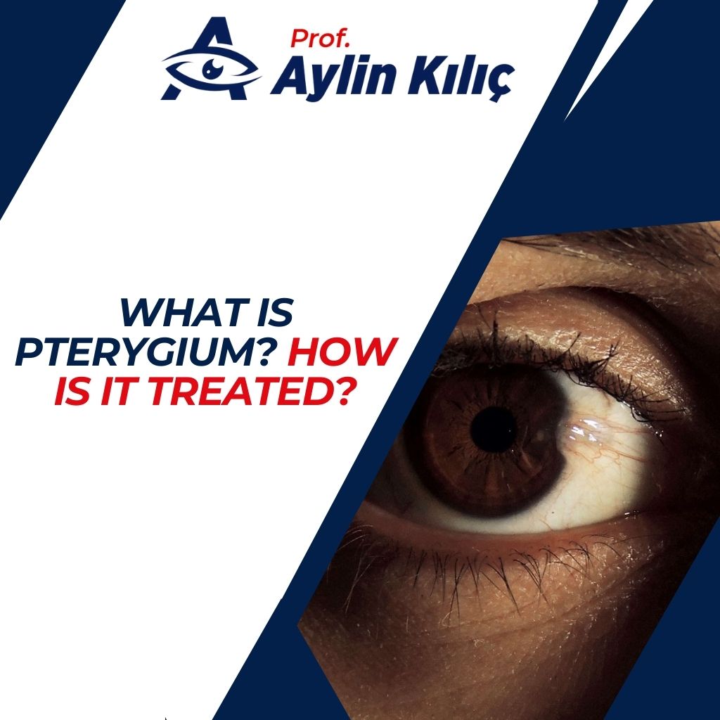 What is Pterygium How is it treated
