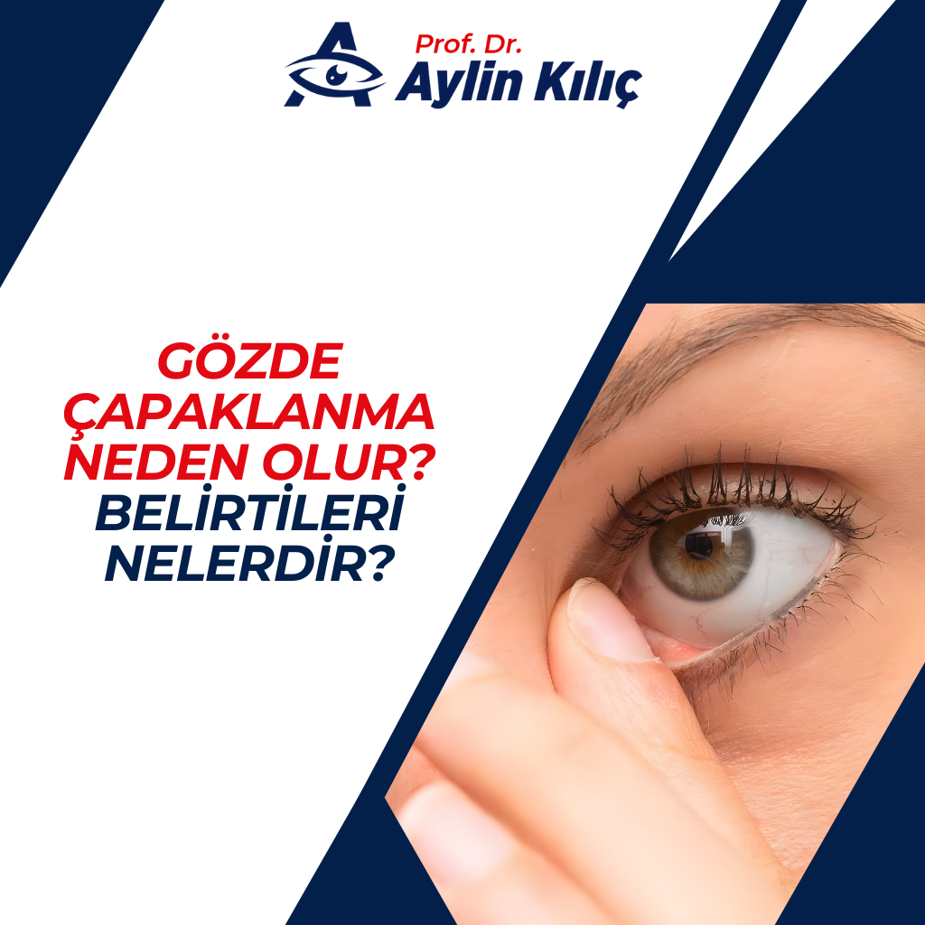 Gözde Çapaklanma Neden Olur