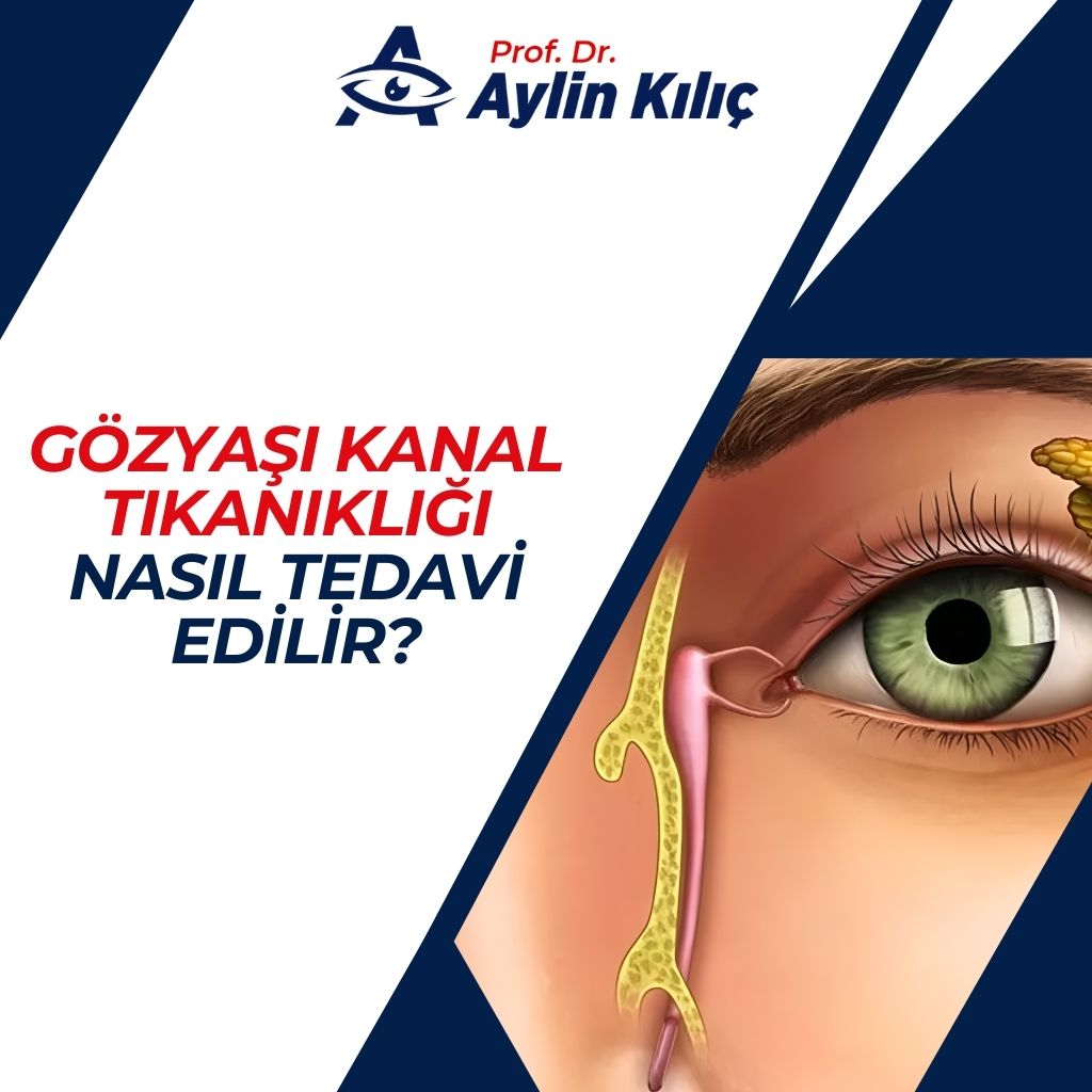 Gözyaşı Kanal Tıkanıklığı Nasıl Tedavi Edilir