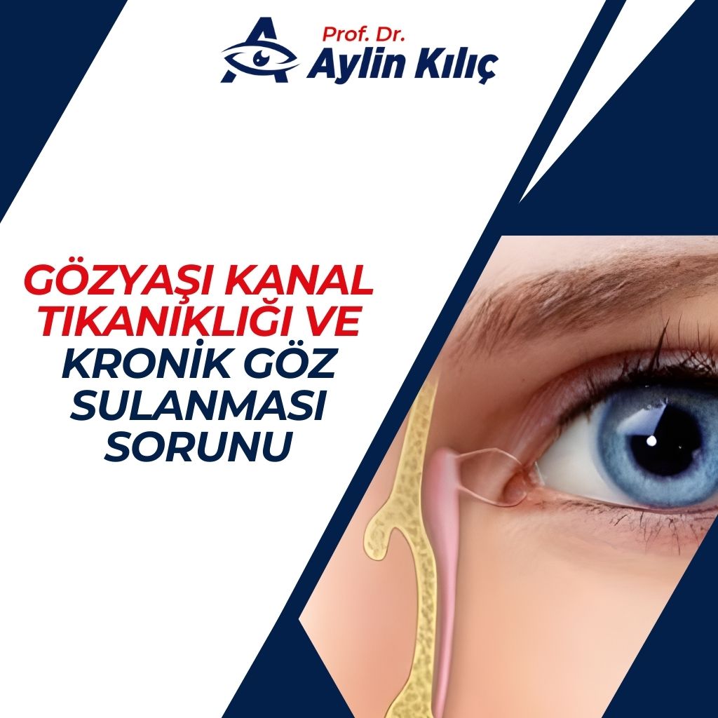 Gözyaşı Kanal Tıkanıklığı ve Kronik Göz Sulanması Sorunu