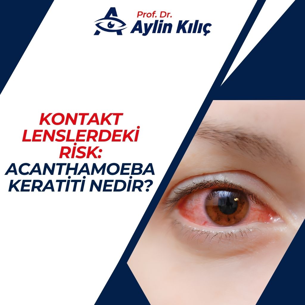 Kontakt Lenslerdeki Risk Acanthamoeba Keratiti Nedir