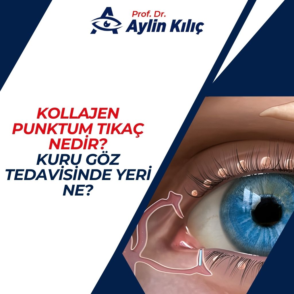 Kuru Göz Tedavisinde Yeri Ne 1