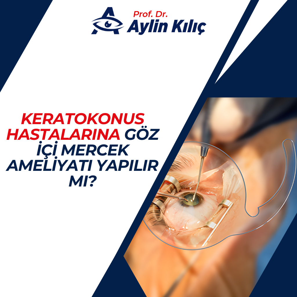 Keratokonus Hastalarına Göz içi Mercek Ameliyatı Yapılır mı
