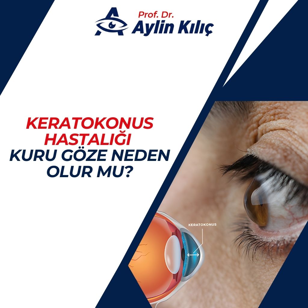 Keratokonus Hastalığı Kuru Göze Neden Olur mu