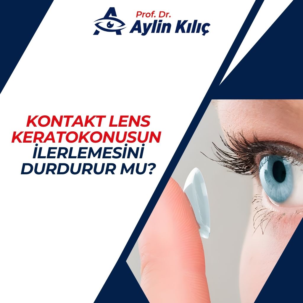 kontakt lens keratokonus