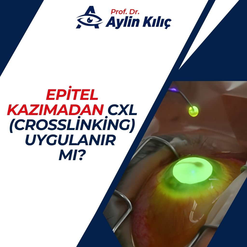 CXL (Crosslinking) Uygulanır mı