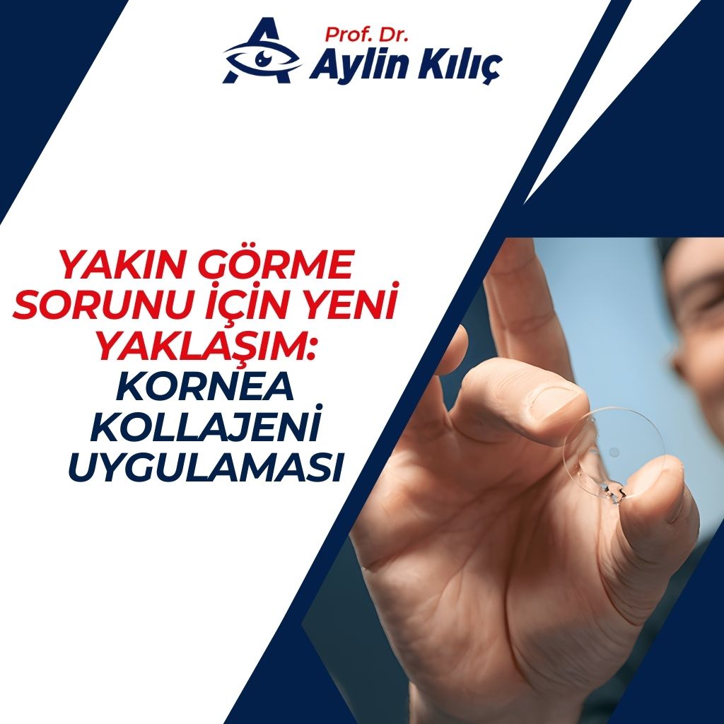 Kornea Kollajeni Uygulaması 3