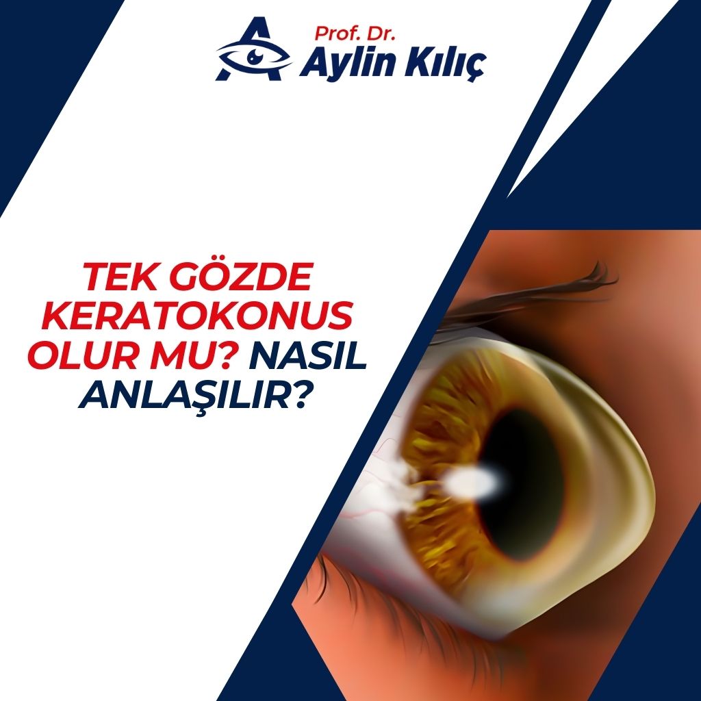 Tek Gözde Keratokonus Olur mu