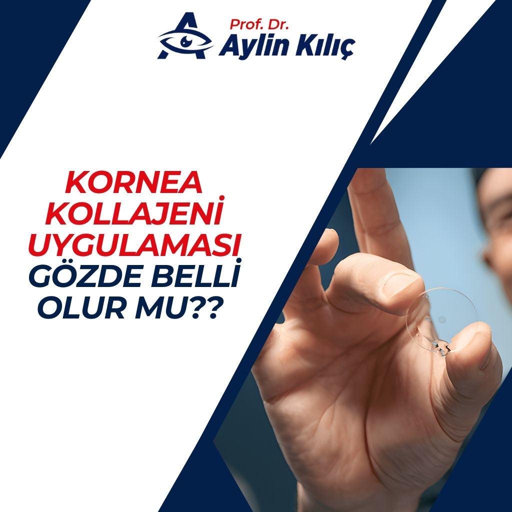 Kornea Kollajeni Uygulaması Gözde Belli Olur mu?